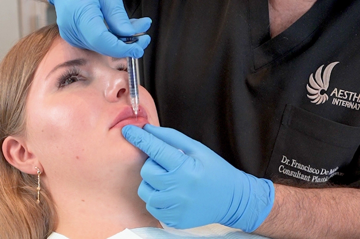 Lips Filler & Lip Augmentation in Dubai | Aesthetics Clinic